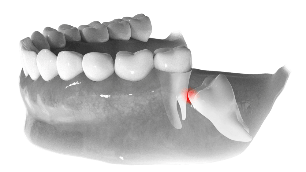 Wisdom Teeth Removal | The Dentists at Grand Parkway | Katy, TX